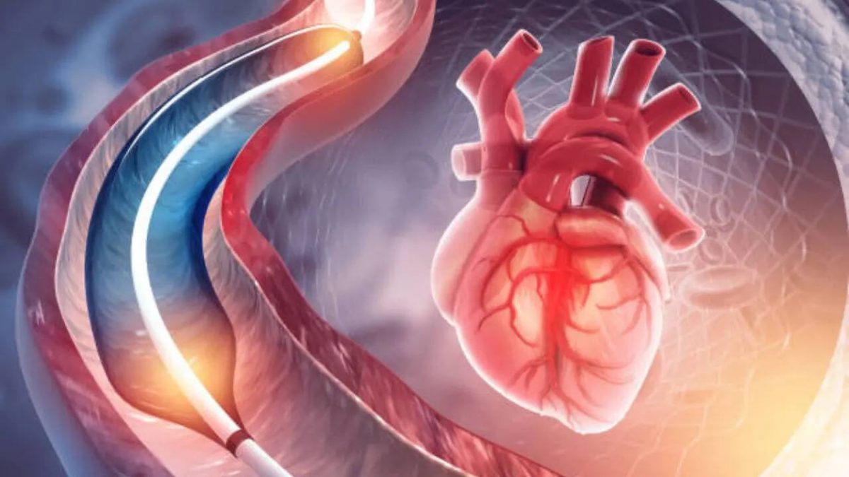 Arzt widerlegt Herz-Mythos: Angiographie ist diagnostisch, nicht therapeutisch